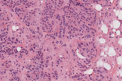 Breast Cancer 40x