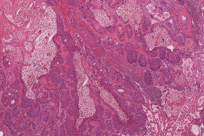 Lung Cancer 40x