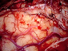 BLUE-400-intraoperative-Fluorescence-whitelight-A-224x168小圖一.jpg