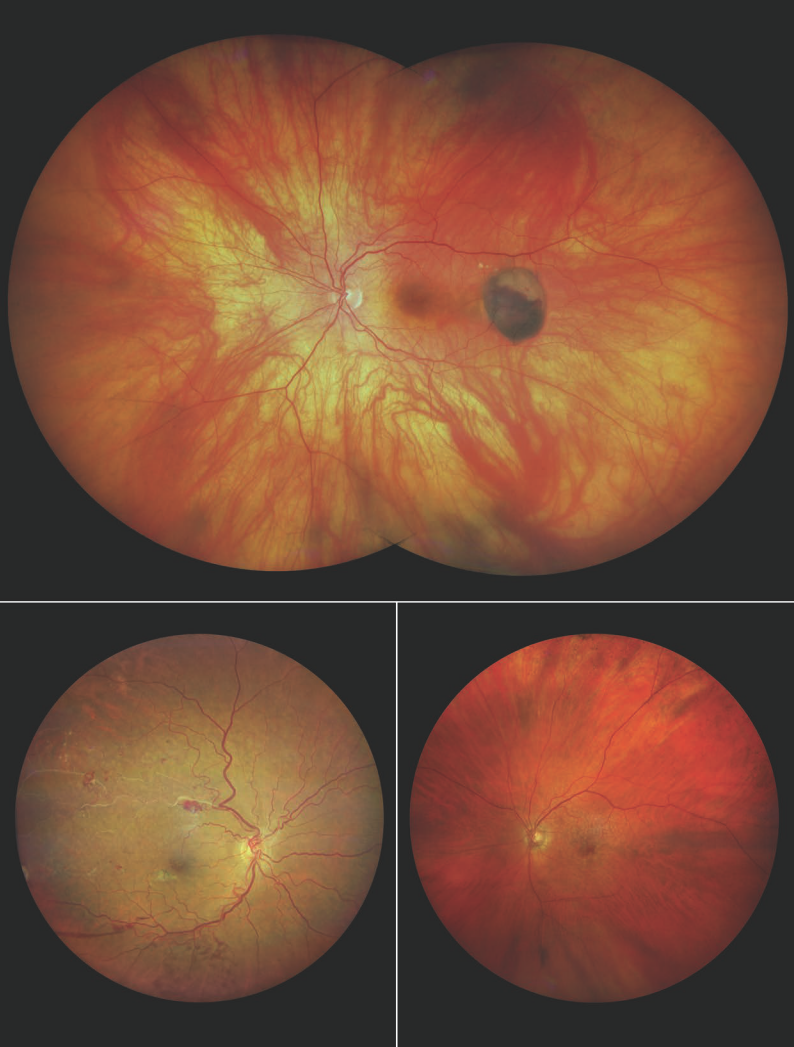 zeiss 新一代 广角眼底照相机 clarus 500