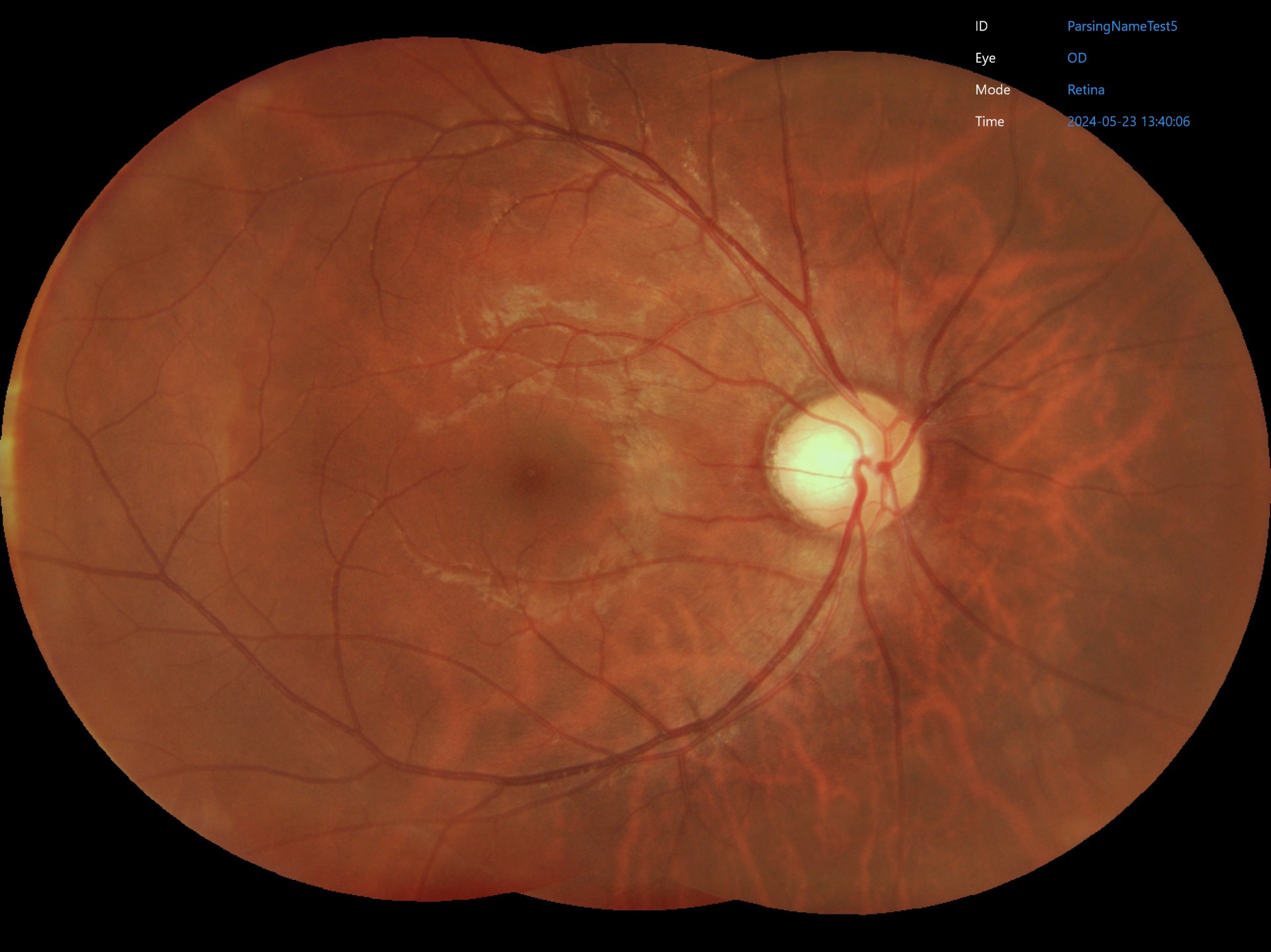 ParsingNameTest5_last_Retina_OD_20240523_134006.jpg